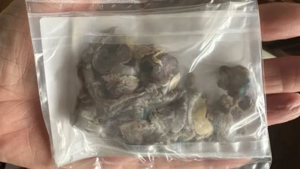 Врачи удалили подростку часть легкого и вернули ее в пакете